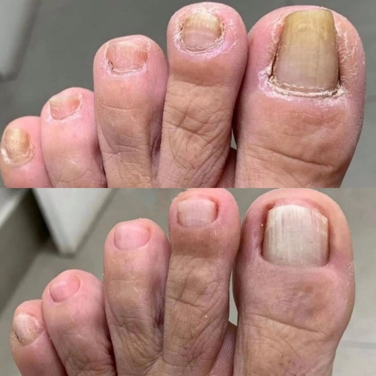 NailPura™