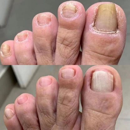 NailPura™