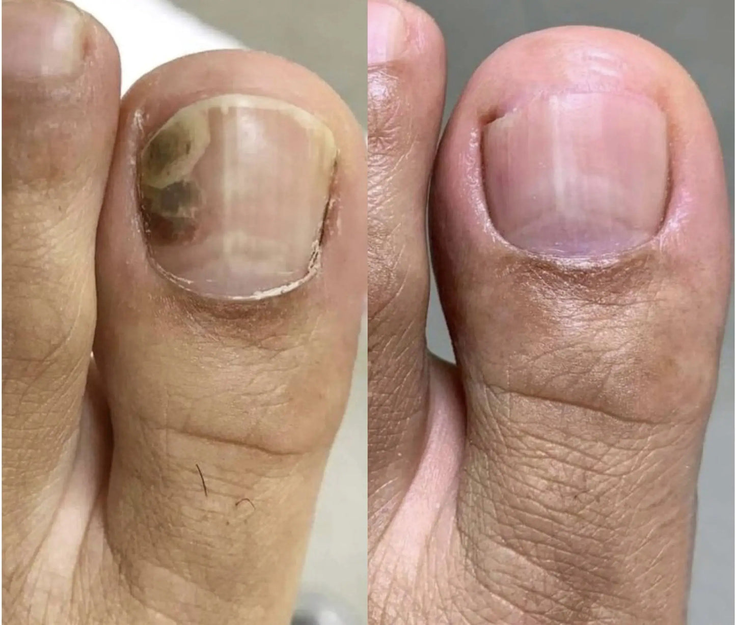 NailPura™