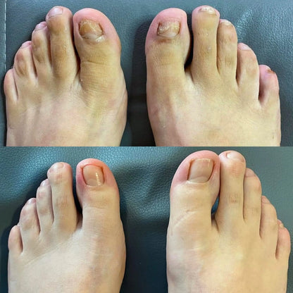 NailPura™