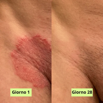 Micotera Pure™